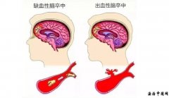 这 7 种表现,是脑中风的预兆,一定要记住,转发给家